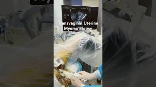 Transvaginal Uterine Myoma Biopsy [upl. by Lucienne]