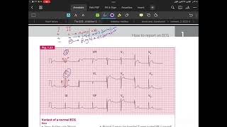 Cardiac axis deviation 🖤 [upl. by Vanhook220]