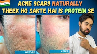 Remove Acne Scars Naturally  3 Remedies 100 Works With Results [upl. by Eidorb]