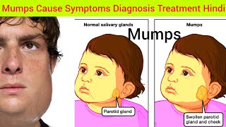 Mumps Cause Symptoms Treatment in Hindi  Cause of Mumps Symptoms of Mumps What is Mumps Mumpa [upl. by Neomah]