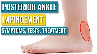 Posterior Ankle Impingement  Symptoms Diagnosis Treatment amp Recovery Time [upl. by Sabine183]