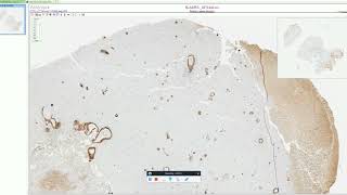 Cerebral Amyloid Angiopathy  Adventures in Neuropathology [upl. by Trout]