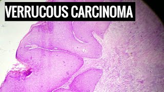 Verrucous Carcinoma Histopathology [upl. by Naej]