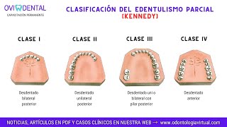 PRÓTESIS DENTAL Clasificación del edentulismo parcial  8 reglas de Applegate [upl. by Akierdna876]