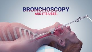 BRONCHOSCOPY  ITS USES I DR NAVEEN KUMAR AILAWADI I CHEST SPECIALIST [upl. by Coppock238]