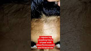 How I regrow my receding hair line with minoxidil finasterideminoxidil hairloss [upl. by Resor]