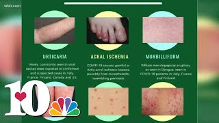 Doctor Skin rash could be a symptom as possible COVID19 symptom [upl. by Annaitat]