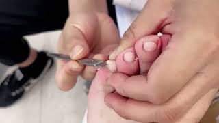 satisfying ingrown toenail removal 010 [upl. by Atinuaj]