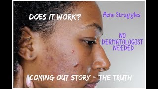 Acne Diaries  With Pics  1 Month Doxycycline  RetinA Tretinoin NO DERMATOLOGIST NEEDED [upl. by Ponzo]