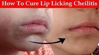 Prevent Cracked Corners of your Mouth that NEVER Heal 3 Tips to Prevent Angular Cheilitis [upl. by Hansiain]