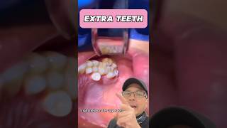 Should You Remove Your Extra Tooth Dentist EXPLAINS  View Mobile Dental shorts [upl. by Rotman]