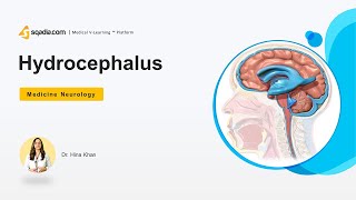 Hydrocephalus  Neurology Medicine Lectures  Study Online  VLearning  sqadiacom [upl. by Anilak175]