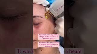 Treating blue veins around the eyes with VBeam Prima laser [upl. by Norga575]