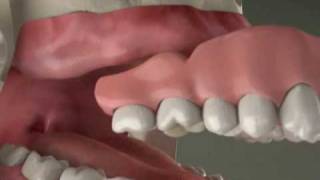 Dental Implants  Implant Overdenture in Denville NJ [upl. by Imrots505]