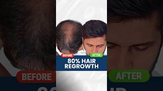 80 Hair Regrowth  Real review  Hair growth  hair fall  Hair loss Adon Hair Care viral shorts [upl. by Duhl]