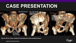 Acute Total Hip Replacement for Geriatric Acetabular Fracture [upl. by Renner]