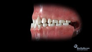 Anterior Crossbite Skeletal or Functional [upl. by Kosey]