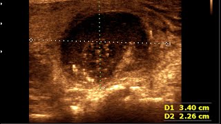 Thyroid colloid cyst  Thyroid cyst  Colloid goiter [upl. by Ativet]