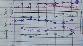 Audiogram  Assessment of Type of Hearing Loss  Part 2 [upl. by Murtha730]