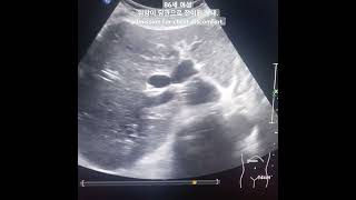 전이담도암metastatic biliary cancer dt stomach cancer [upl. by Vincenz]