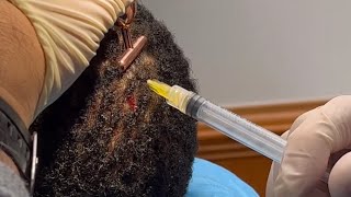 Scalp PRP for Hair Loss [upl. by Leifer]