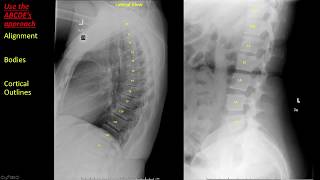 Introduction to Spine Radiographs [upl. by Assenal]