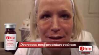 CO2 Laser Skin Tightening PostProcedure Treatment [upl. by Harriett]