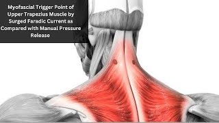 Myofascial Trigger Point of Upper Trapezius Muscle by Surgerd Faradic Current [upl. by Ahsekat51]