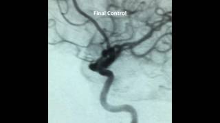 WEB Treatment of Unruptured 7 mm MCA Aneurysm [upl. by Yolanda931]