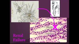 Tumor Lysis syndrome quotEM in 5quot [upl. by Bruce]