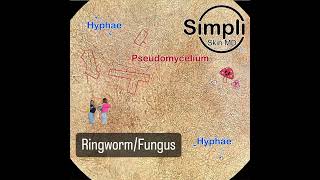 Ringworm  Fungus [upl. by Enitsirhk956]