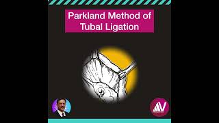 Parkland Method of Tubal Ligation [upl. by Eerrehc805]