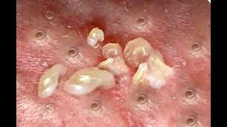 Shocking Cystic Blackheads amp Whiteheads Extraction Revealed  new blackheads this week 12301 [upl. by Senzer41]