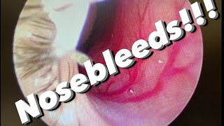 Nosebleeds epistaxis causes prevention treatments and more [upl. by Oivat]