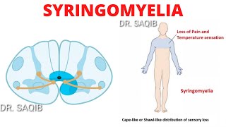 Syringomyelia [upl. by Bogoch489]