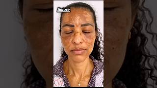 Remove pigmentation in 30 minutes 😲at home  homeremedies skincare [upl. by Marco]