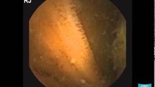 Small Bowel Tumor Detection in Capsule Endoscopy [upl. by Filahk]