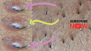 Ingrown hair  thick facial hair extraction [upl. by Eimerej189]