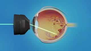 Medication Injection and Laser Surgery for Macular Edema [upl. by Chung]