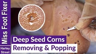 DEEP SEED CORNS REMOVING AND POPPING BY MISS FOOT FIXER MARION YAU [upl. by Luane]