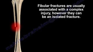 Fibular Fracture isolated Everything You Need To Know  Dr Nabil Ebraheim [upl. by Buckie]