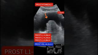 Ultrasound showing Enlarged prostateprostatomegaly ultrasound [upl. by Nad332]