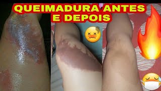 QUEIMADURA ANTES E DEPOIS MINHA CICATRIZ [upl. by Ahsenrat]