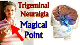 Acupressure Points For TRIGEMINAL NEURALGIA Acupressure For Trigeminal Neuralgia MADE EASY  HINDI [upl. by Katzir]