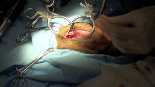 Excision arthroplasty [upl. by Vasilek]