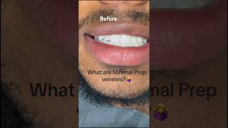 Minimal Prep Veneers defined what the preparation looks like [upl. by Yssor338]