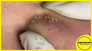 Full Video BEST REMOVAL BLACKHEADS AND WHITEHEADS ON NOSE [upl. by Orpheus]