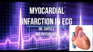 Myocardial Infarction MI ECG in HIndi [upl. by Danete]