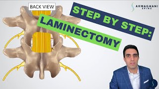 Step by step how to perform a lumbar laminectomy [upl. by Yona]