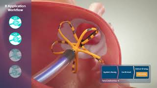 FARAPULSE™ Pulsed Field Ablation System Animation [upl. by Gem913]